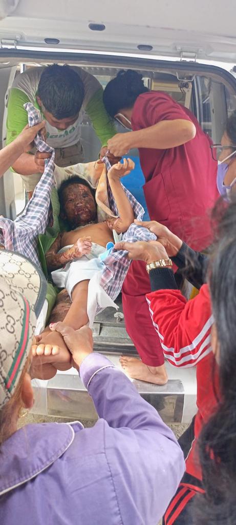 Polri Peduli, Polres Simalungun Berikan Bantuan Tali Asih Kepada Korban Luka Bakar